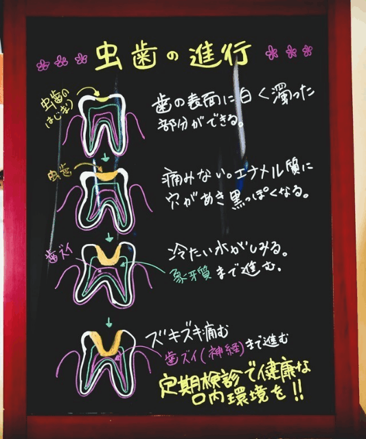 虫歯の進行の説明